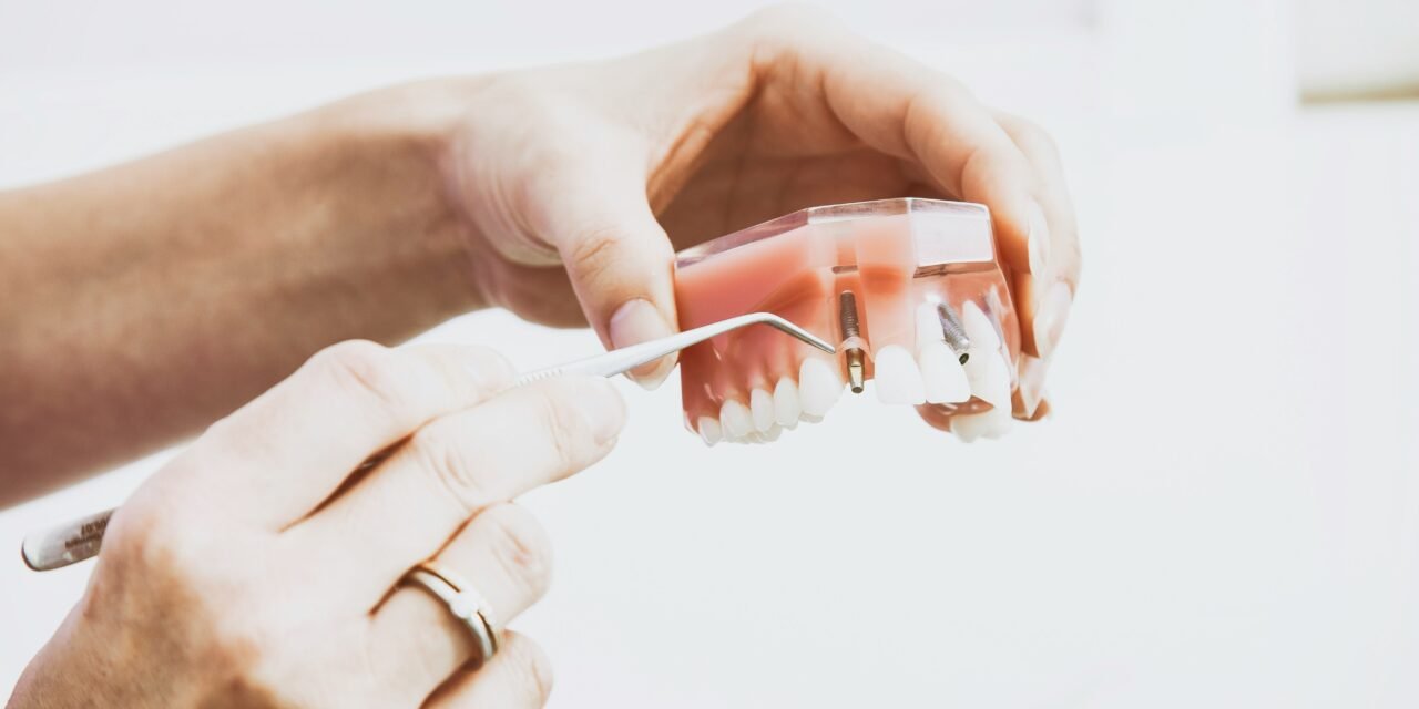 Dentalni implantati – trajno rješenje za novi osmijeh!